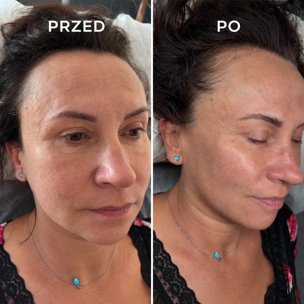 Przed i po — poprawa kondycji skóry, Atelier Książenice